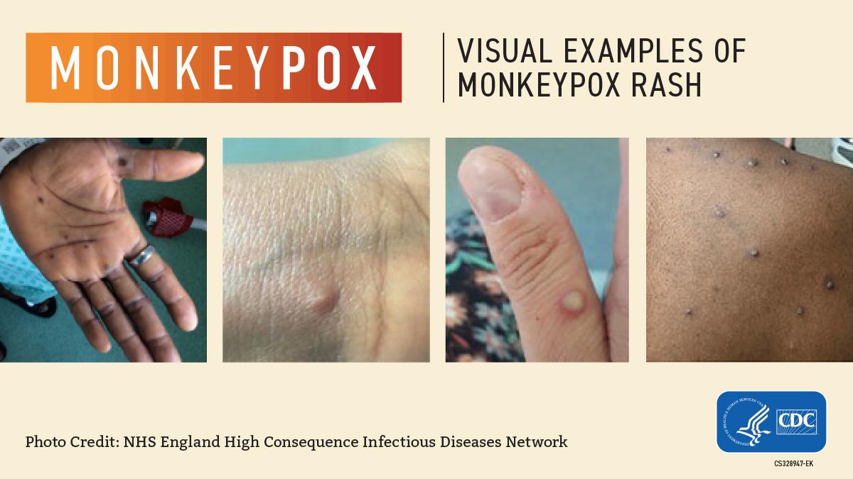 Mpox Virus: Gejala, Penyebab, dan Pencegahan